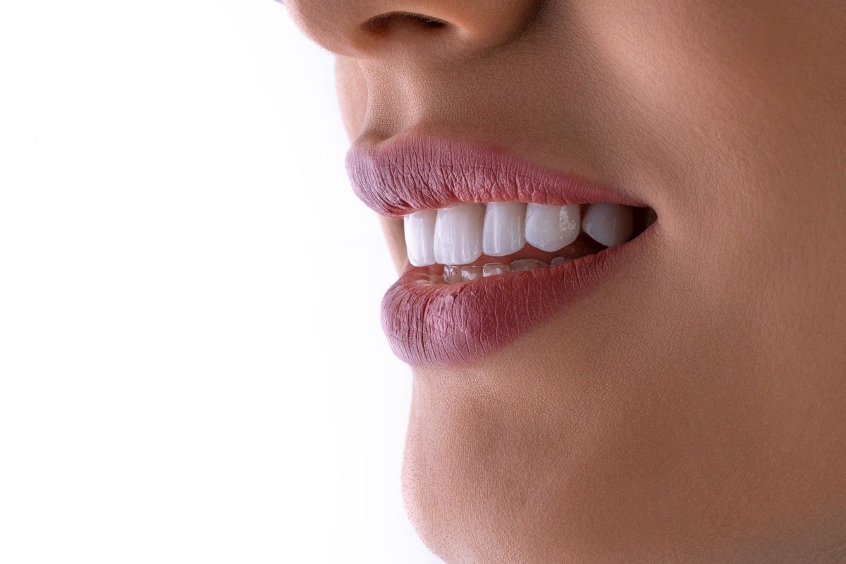 Teeth Whitening